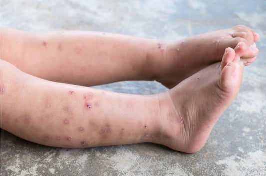 Cuidado de la Dermatitis Atópica en Niños: Causas, Tratamientos y Recomendaciones